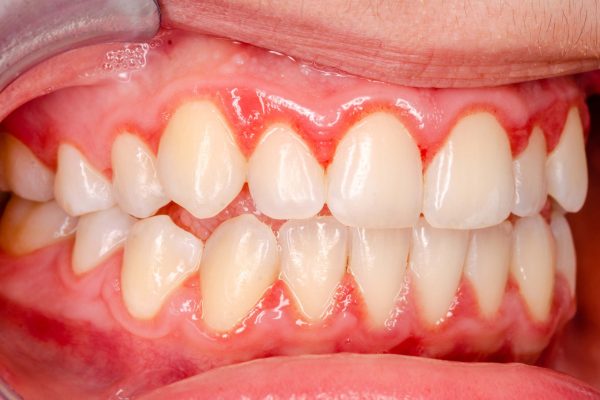 gingivitis