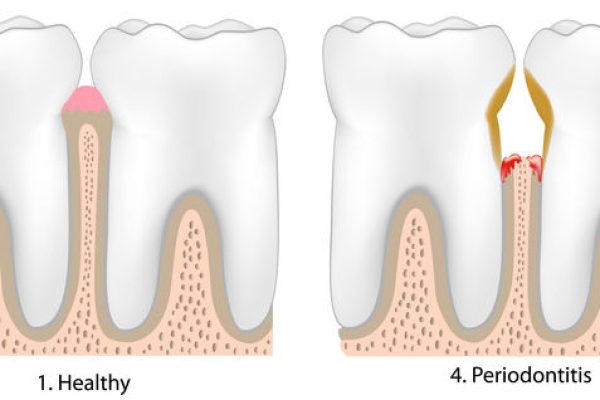 gum disease Los Angeles