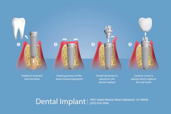West Hollywood Dental Implants