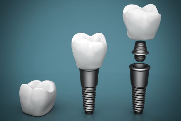 Dental Implants