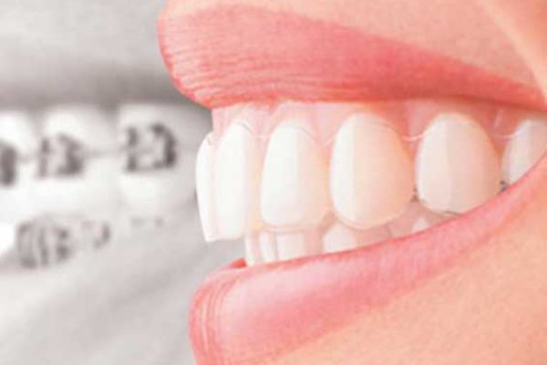 Invisalign
