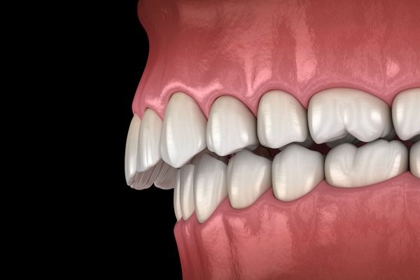 Overbite treatment