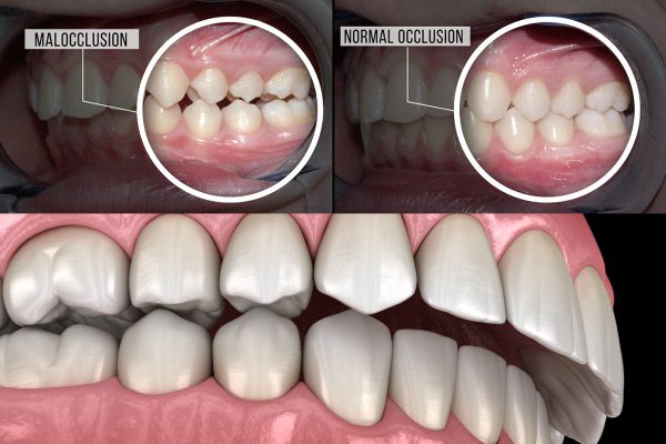 overbite and underbite treatment