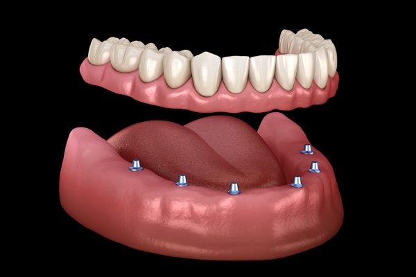 Overdentures