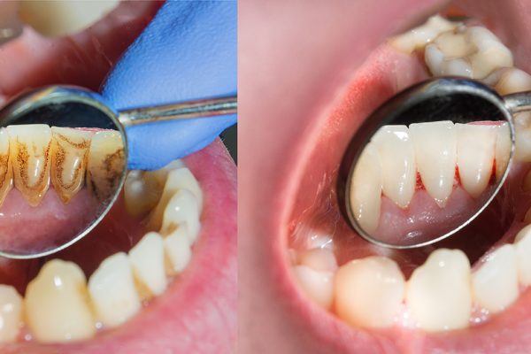 Dental Plaque and Tartar