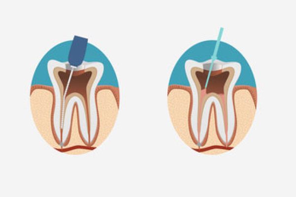 root canal west hollywood
