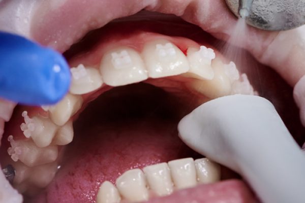 fluoride-free dentistry