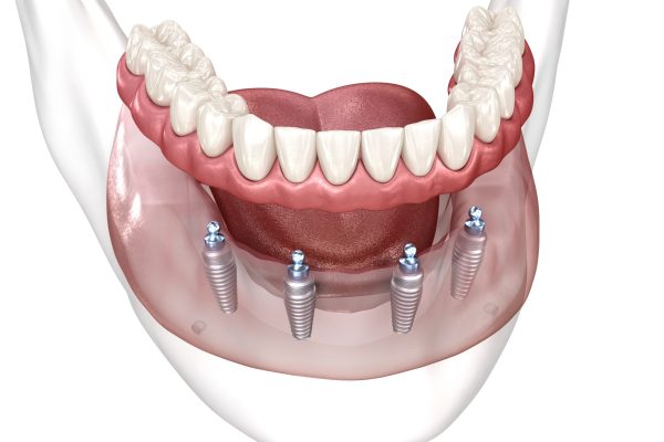 All-on-4 Dental Implants Beverly Hills