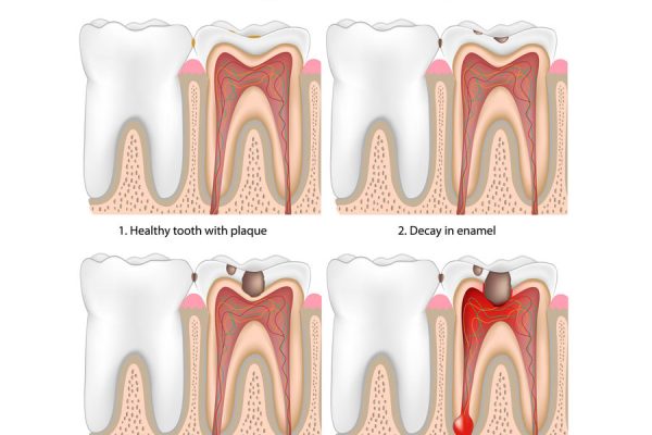 stages of tooth decay