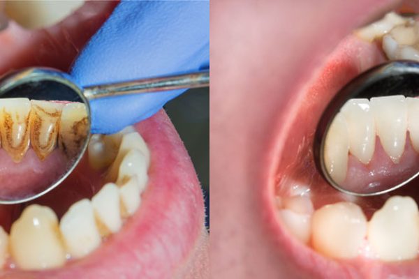 teeth cleaning cost Los Angeles
