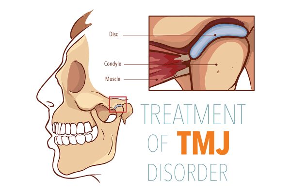 TMJ treatment Los Angeles