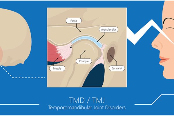 TMJ treatment West Hollywood
