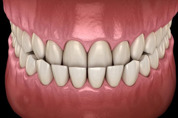 underbite treatment