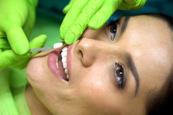 Veneers life Span