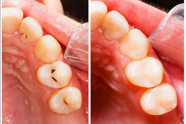 Metal Free Dental Fillings