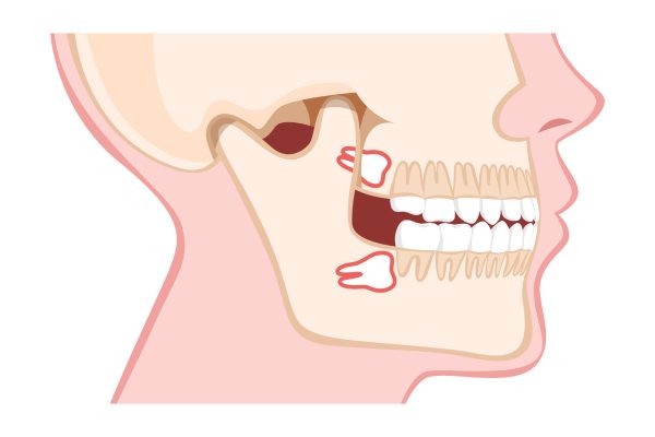 wisdome-teeth